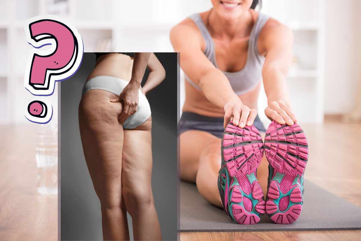 Cellulite- rimedi