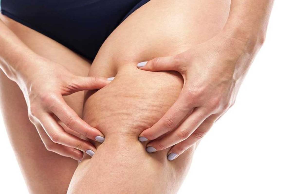 Cellulite sulle gambe-rimedi