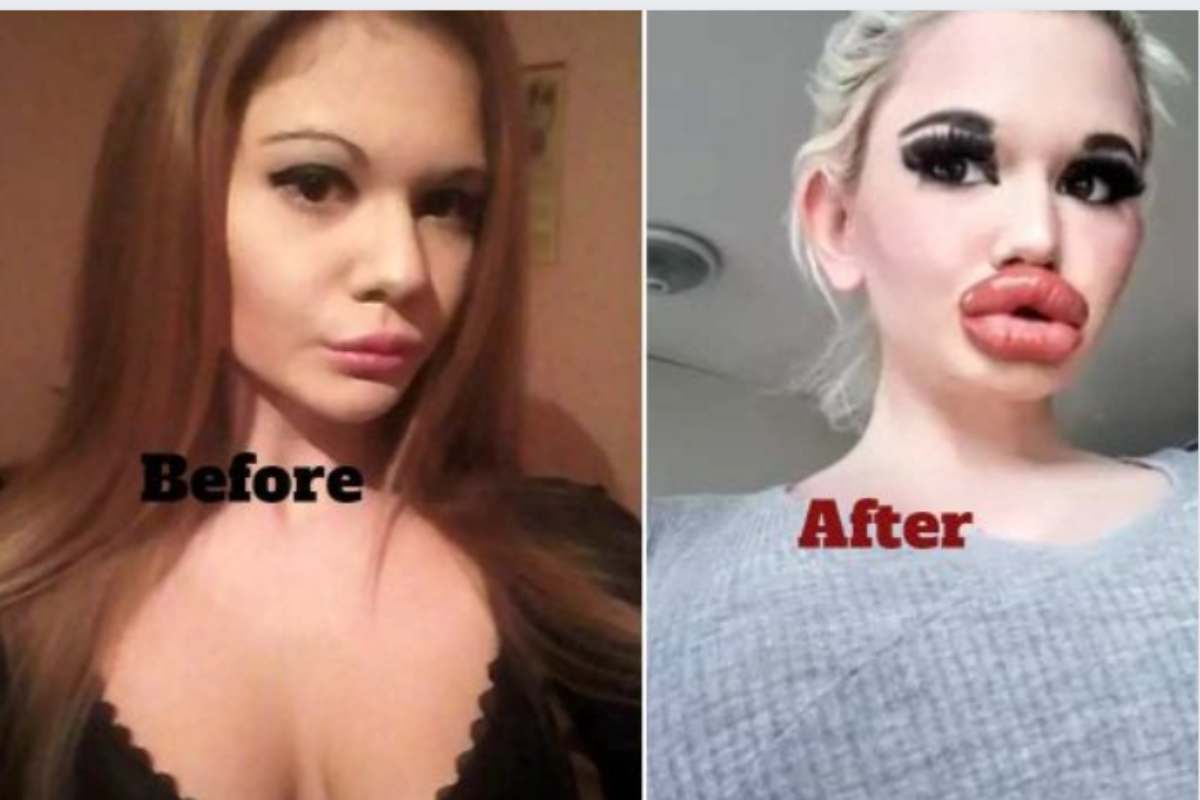 Andrea Ivanova prima e dopo la donna con le labbra più grosse del mondo