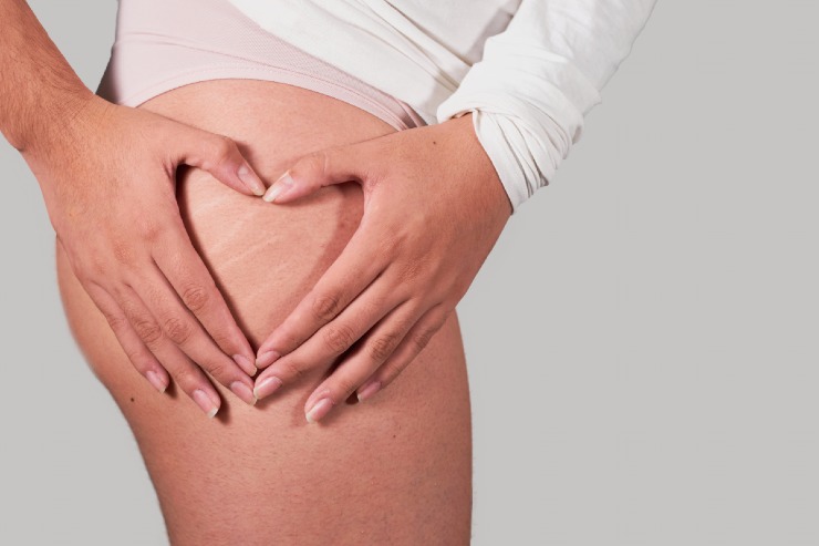 Cellulite ritenzione idrica 