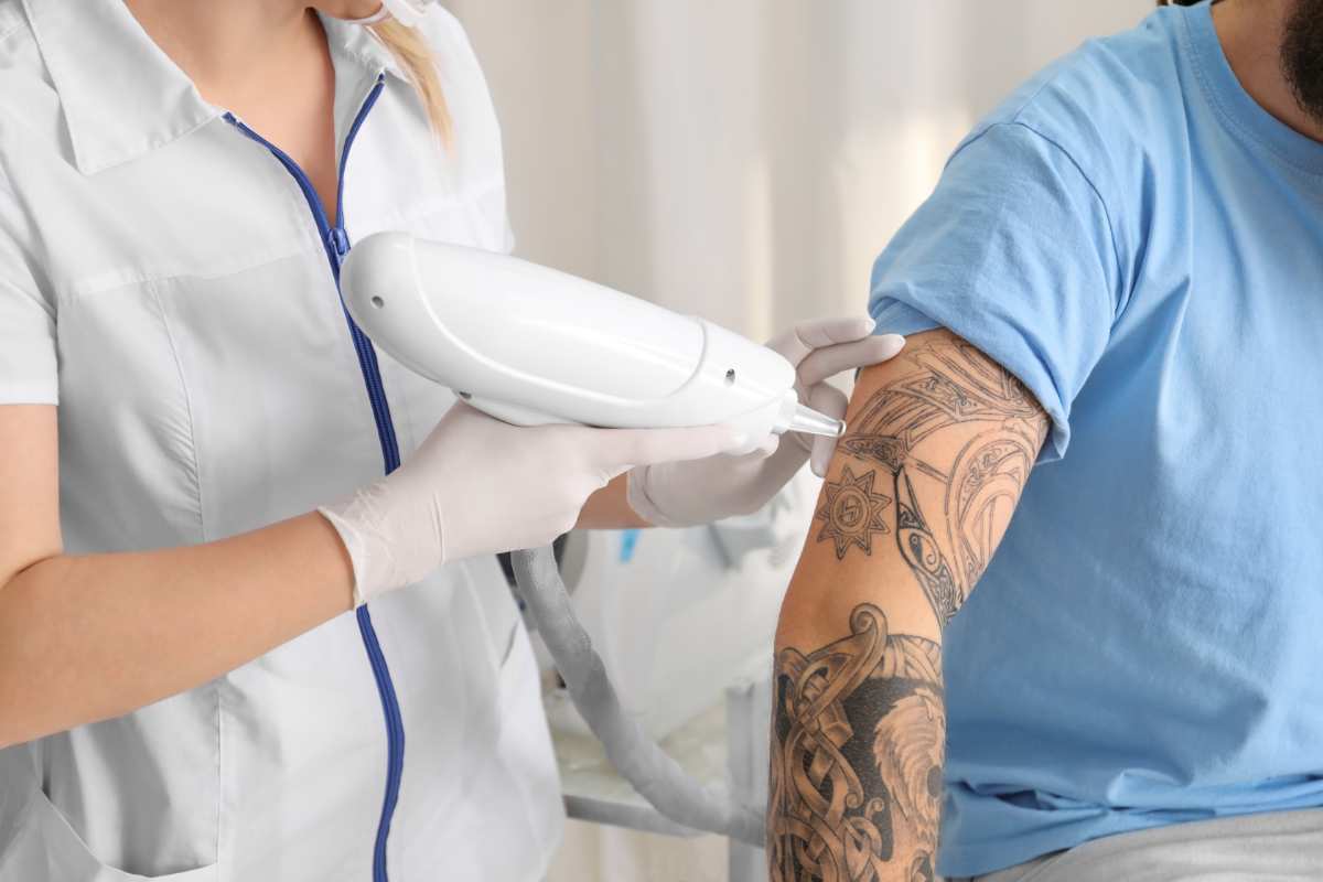 Rimozione tatuaggio, come farlo in sicurezza e i costi